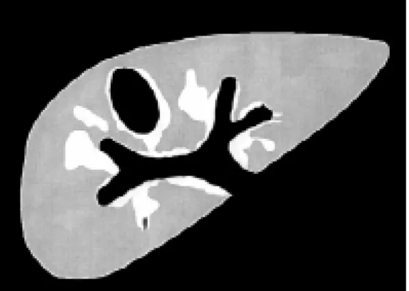 Fig. 8: image pattern F (very advanced central and periph- periph-eral periportal thickening)