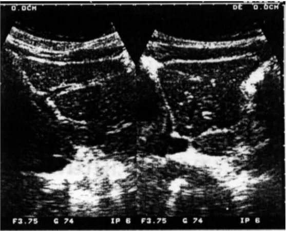 Fig. 2 demonstrates hepatic lesions suggestive of peri- peri-portal thickening in a non-infected person.
