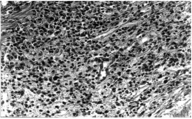 Fig. 4: lymphomonocytic infiltration in the submucosa of mouse gastric corpus (GA1) at the 14th day post-inoculation