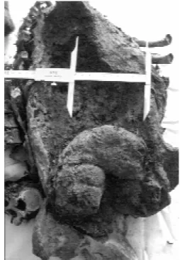 Fig. 3: general view of the torso of the SMM mummy.  The calipers are opened to a width of 10 cm