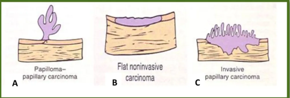 Figura nº2: ilustração de diferentes tipos histopatlógicos de CCT. O mais comum no humano é o  carcinoma papilar-papiloma (A)