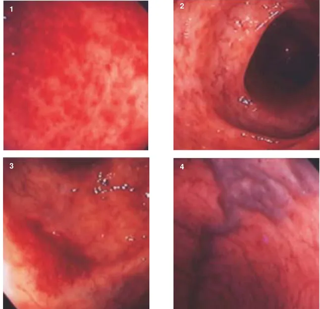 Fig. 1: rectal erythemas. Fig. 2: colonic telangiectasias. Fig. 3: colonic angiodysplasia
