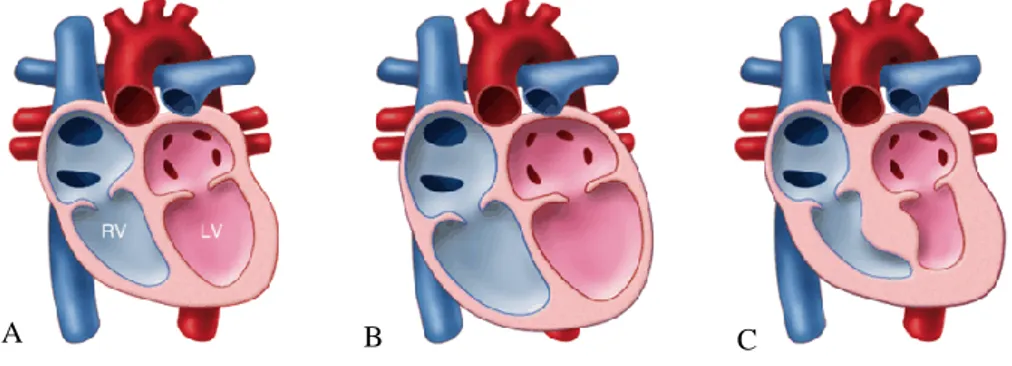 Figura  1-  Alterações  morfológicas  nas  cardiomiopatias.  A -  coração  normal. B  -  cardiomiopatia  dilatada