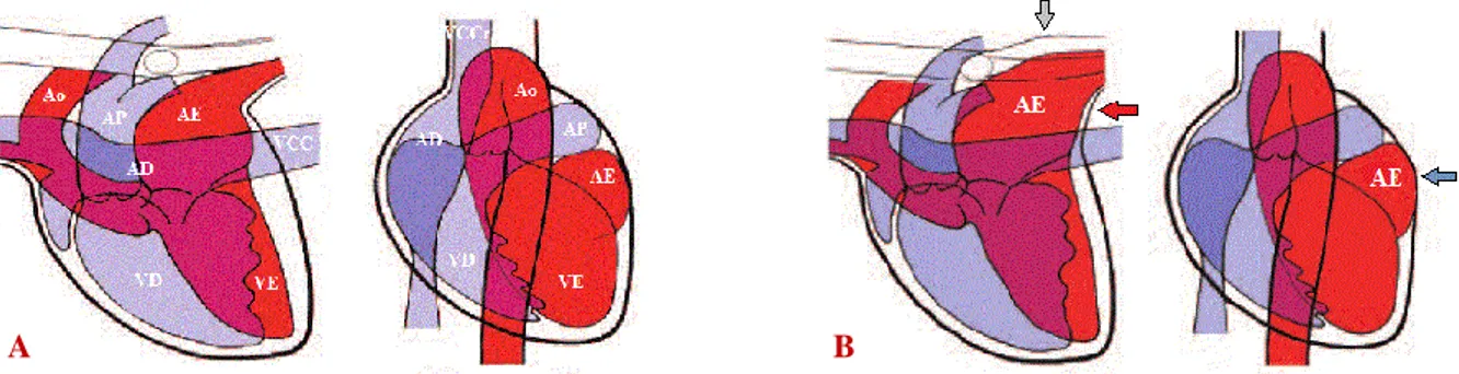 Figura  8  -  Silhueta  cardíaca  normal  (A)  e  com  aumento  do  átrio  esquerdo  (B)