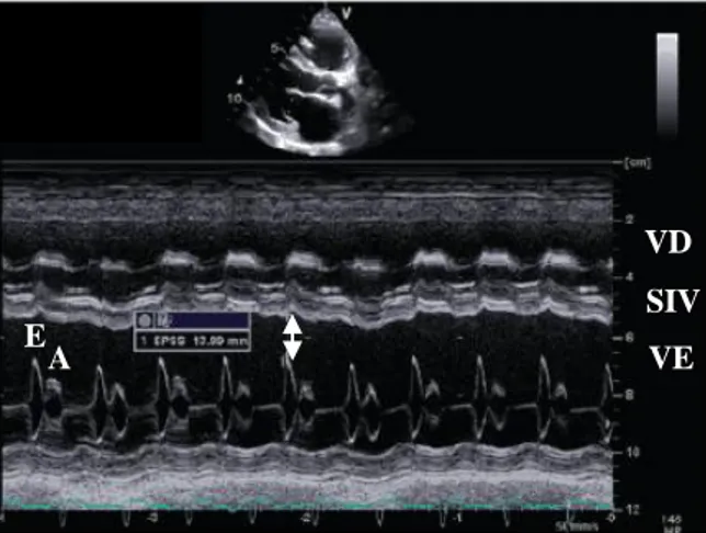 Figura 14 – Plano paraesternal direito de eixo longo,  modo M ao nível da artéria aorta