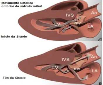 Figura 5 – Esquema da obstrução do trato de  saída  do  ventrículo  esquerdo  num  gato  com  cardiomiopatia  hipertrófica