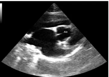 Figura  9  –  Dilatação  atrial  num  gato  com  cardiomiopatia  hipertrófica.  Nesta  ecografia  em  modo  B,  do  plano  paraesternal  direito,  de  eixo  curto,  ao  nível  a  artéria  aorta,  observa-se  que  existe  o  aumento  do  tamanho  do  átrio 