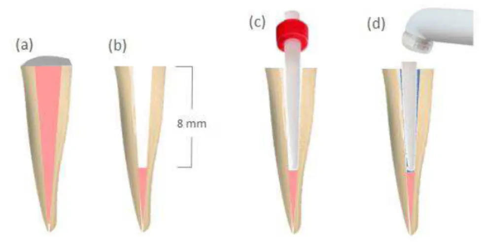 Figura  7  -  Representação  esquemática  (a)  de  um  dente  pré-molar  unirradicular  com  conduto  obturado, (b) porção do conduto radicular que foi desobturada (8 mm), (c) pino de vidro no interior do  conduto  radicular  preparado  e  (d)  fotopolimer
