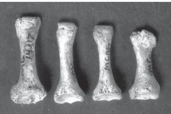 Fig. 5: example of spondyloarthopathy (Marco Gonzalez burial 14/