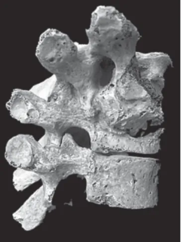 Fig. 1: spinal tuberculosis. The affection of the upper thoracic ver- ver-tebrae resulted in the collapse of T2 and ankylosis of T1-3