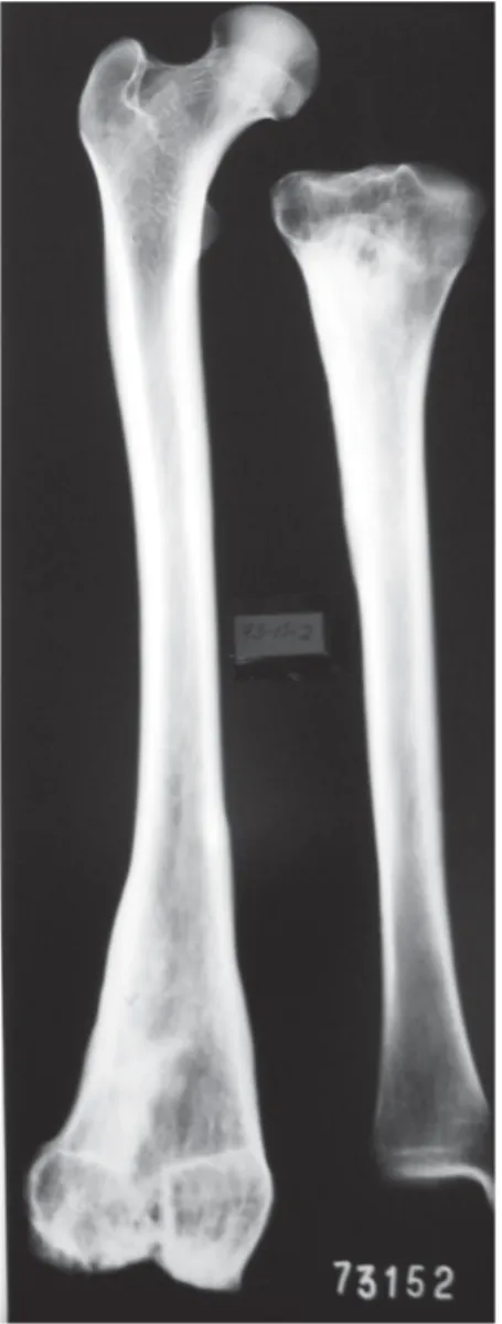 Fig. 34: osteoarthritis of the knee joint with a healed fracture, and cyst. Bar: 1 cm.