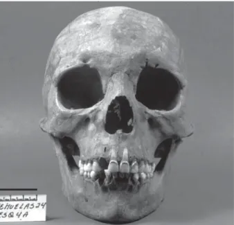 Fig. 1: frontal view, adult female, 45-50 years. Bar = 3 cm.