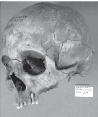 Fig. 9: abscess (left maxillary PM1). Bar: 3cm.