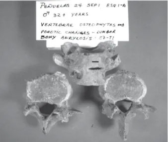 Fig. 14: lumbar osteophytes. Bar: 1 cm.