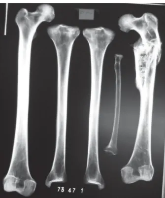 Fig. 25: proximal fracture of the left femur, anterior view. Bar: