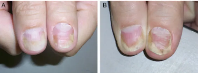 Figure 1 The thumbs of the patient mainly show nail bed involvement with  subungual hyperkeratosis, salmon spot, and onycholysis.