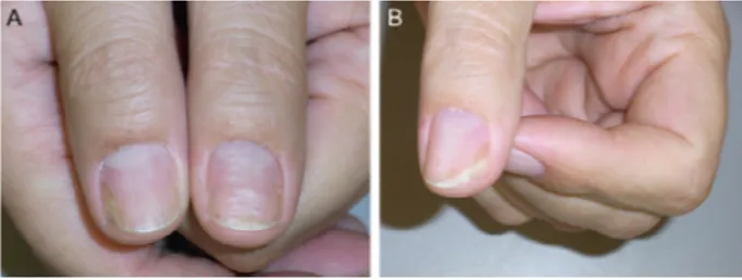 Figure 3 As  topical  and  injection  treatments  are  insufficient  and  inconvenient,  systemic methotrexate is instituted.