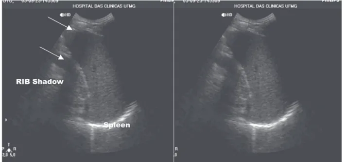 Fig. 2 shows the distribution of patients with palpable and non palpable spleen by physical and US examination,