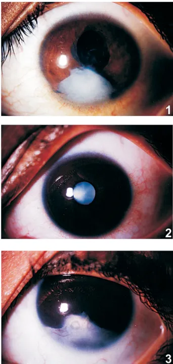Fig. 1: photograph of the left eye of Case 1, with anterior chamber show- show-ing a white mass inferiorly