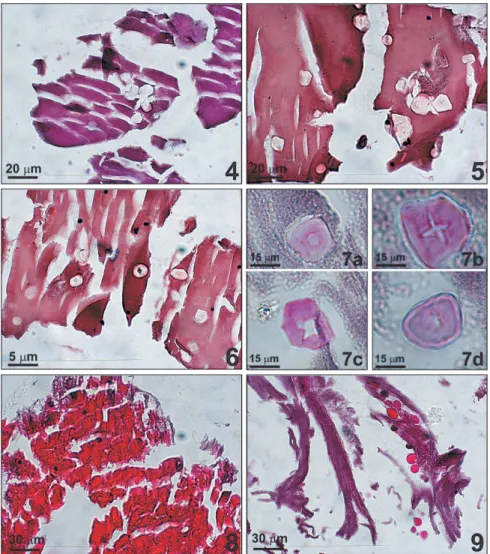 Figs 4-6: scutelliform gemmoscleres of freshwater sponge Drulia uruguayensis  mixed with eosinophilic acellular and fragmented  bands of lens cortex of two patients (4:HE; 5:Sirius red pH10.2; 6:PAS)