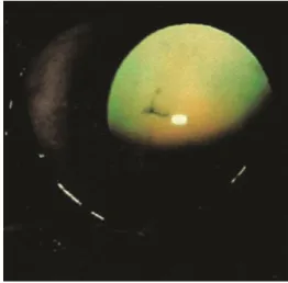 Figura  7:  Catarata  incipiente.  Opacidade  focal  branca  central,  contra  o  reflexo  avermelhado do fundo do olho  (Maggs  et  al., 2013)
