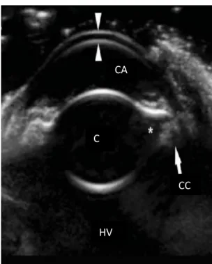 Figura  25:  Ecografia  que  mostra  uma  catarata  cortical  anterior  e  posterior  num  olho  de  cão