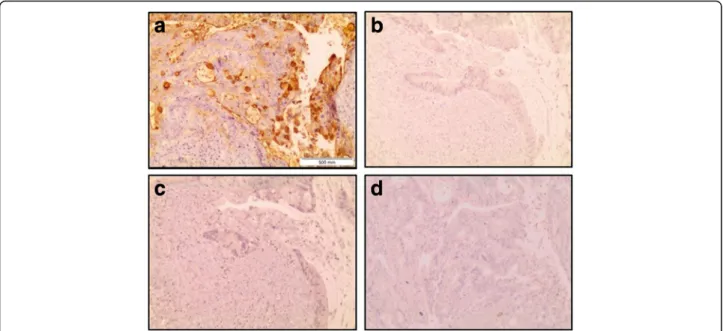 Fig. 3 Specificity of the immunohistochemistry staining of colon adenocarcinoma tissue with E-Ig chimera