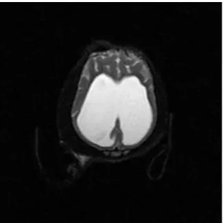 Figura  10.  Imagem  dorsal  de  RM  ponderada  em  T2  onde  se  observa  a  dilatação  severa  de  ambos  os  ventrículos  laterais  e  a  fina  espessura  do  cortéx  cerebral que os envolve