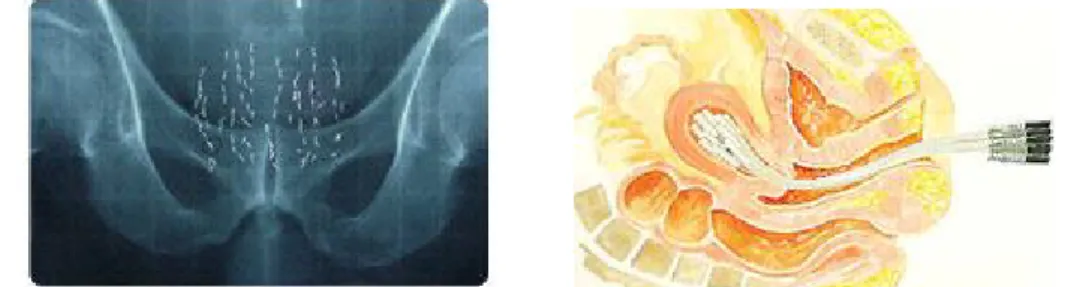 Figura 1 – Braquiterapia Intersticial. Sementes de iodo localizadas na próstata. 