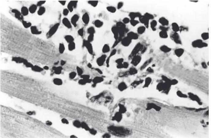 Fig. 6:  minimal rejection unit in Chagas heart disease. Amputation of a heart myofiber is effected by mononuclear cell infiltrates