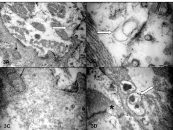 Fig. 2: ultrastructural aspects of an indeterminate asymptomatic form  endomyocardial  biopsy