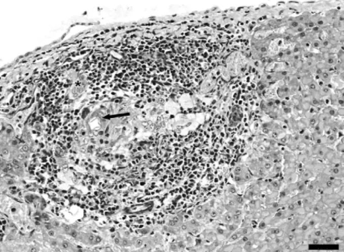 Fig.  1:  liver.  Subcapsular  granuloma  composed  by  numerous  mac- mac-rophages  and  lymphocytes,  some  multinucleate  giant  cells  (*)  and  eosinophils, in the center refractile material similar to larvae cuticula  (arrow)