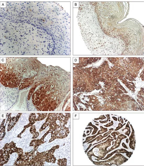 Fig. 1: correlation of p16 INK4a  expression with histologic features of cervical lesions