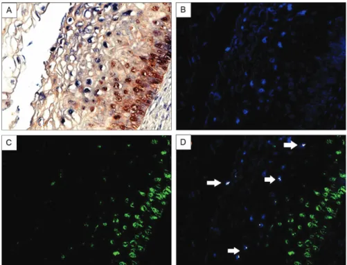 Fig. 3: co-expression analysis of p16  INK4a  and human papilloma virus (HPV) DNA 16 in low-grade cervical intraepithelial neoplasia (CIN)