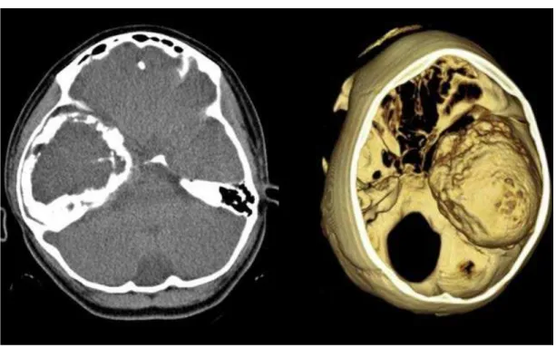 Figure 1. Computed tomography without contrast injection shows a mass lesion surrounded by a thick calcified  capsule, in the right temporal lobe
