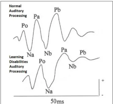 FIGURE 1 | Auditory middle latency responses (AMLR) traces—normal processing × non-normal auditory processing.