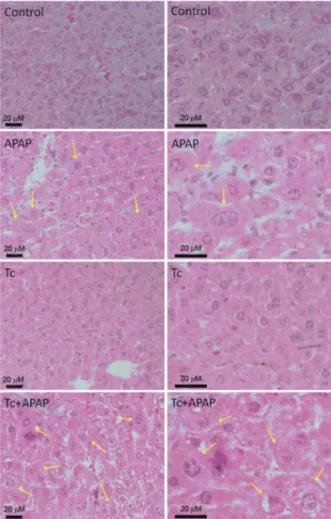 Fig. 3: number of ballooned hepatocytes in Taenia crassiceps-infected  mice following acetaminophen (APAP) overdose