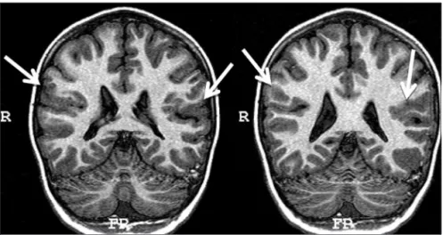 Fig 2. T1 image. MRI study of second twin with  bilateral posterior parietal polymicrogyria.