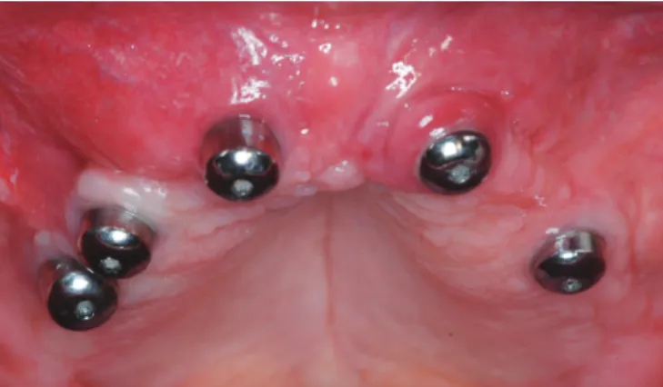 Figura 1. Aspecto clínico inicial dos implantes, em que se observa  ausência de mucosa queratinizada e inflamação da mucosa ao redor  de cicatrizadores.