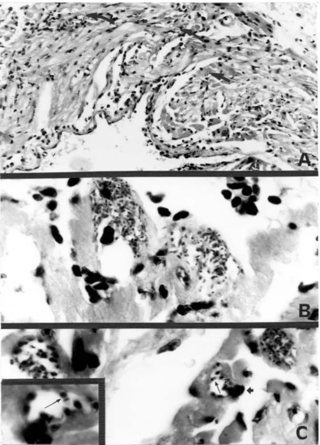 Fig. 3: histopathological lesions in myocardium of Balb/C mice, experimentally infected with Trypanosoma cruzi isolated from feces of triatomine bugs used in the xenodiagnoses procedure