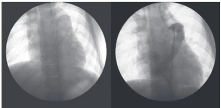 Fig. 2 – Enlarged azygos vein (AV) and hemi-azygos vein (HAV); suprahepatic veins (SHV) and aorta (AO); enlarged azygos system (arrow) to the left of the aorta emptying into the renal veins