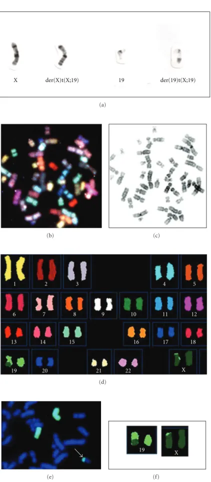 Figure 2: (a) GTG-banded partial metaphases. Chromosomes are (from left to right): normal X, der(X), normal 19, and der(19)