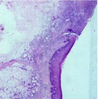 Figure 4. Biopsy exhibiting a slightly hyperplastic epithelium, limiting the ulceration surface, with  both the foci of necrosis and some minor salivary glands in pre-necrotic status in the underlying  connective tissue