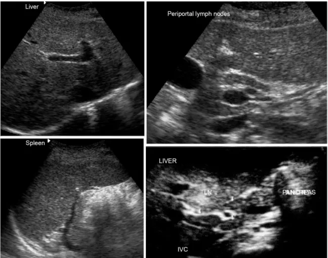 Fig. 2: sonographic features of acute schistosomiasis: non specific liver and spleen enlargement (left); enlarged periportal lymph nodes (right) with  normal cortical hipoechogenicity surrounding a central echogenic hilum
