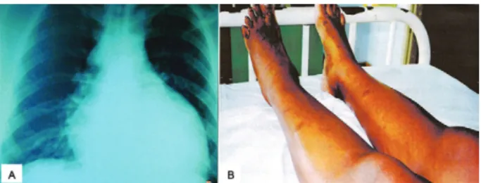 Fig. 5: acute case of Chagas disease by oral transmission showing X  ray heart enlargement (A) and oedema on the legs with skin necrosis  (B) (Pinto et al
