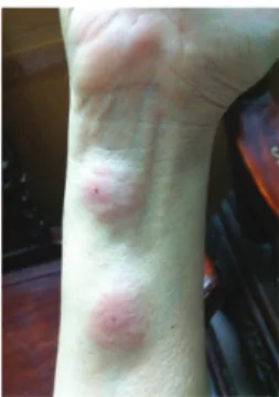 Fig. 2: local skin reaction to the bite of Triatoma rubrofasciata (photo  by one the authors, TXL).