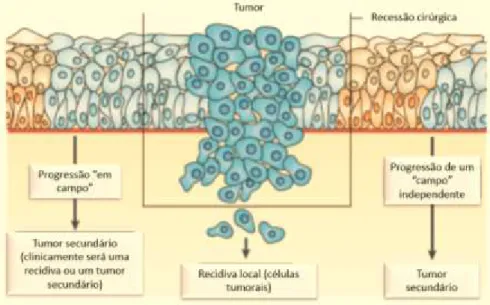 Figura 6. O fenómeno da cancerização em campo e recidiva (Adaptado de Leemans et al., 2011)  