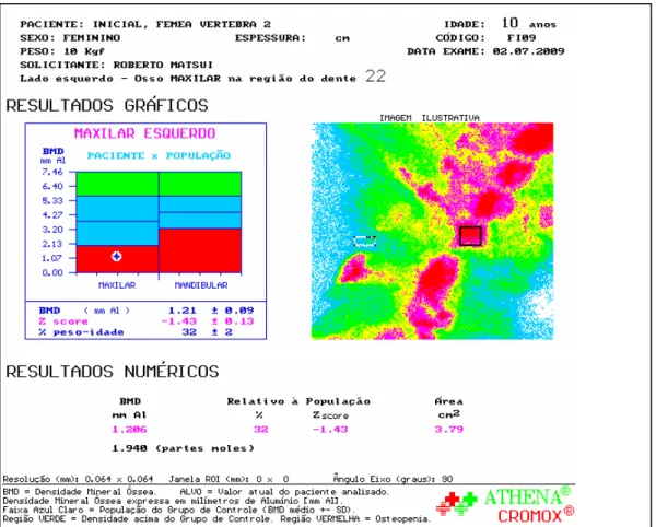 Figura 6 - Resultado da densitometria óssea da fase inicial do crescimento 