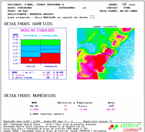 Figura 8 - Resultado da densitometria óssea da fase final do crescimento 