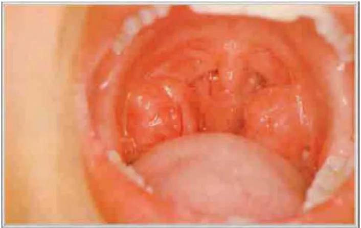 Figura 2. Exame de orofaringe. Classificação das tonsilas grau III. 